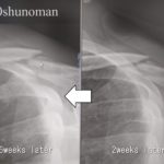 左鎖骨レントゲン写真（事故後6週間後と2週間後の比較）